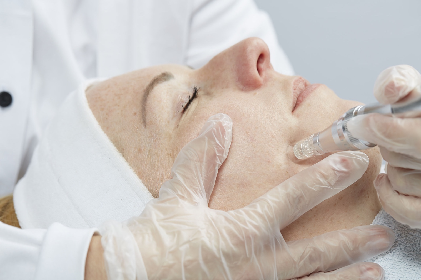 Microneedling